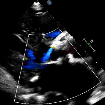 ACC 2019: TAVR for low risk patients / FDA approves MitraClip for ...